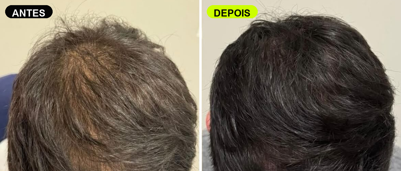 Antes e depois de tratamento capilar M Hair