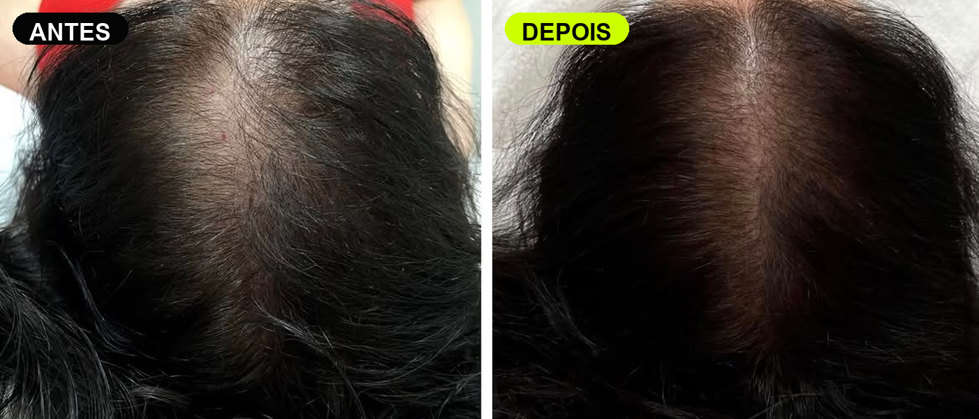 Antes e depois de paciente M Hair