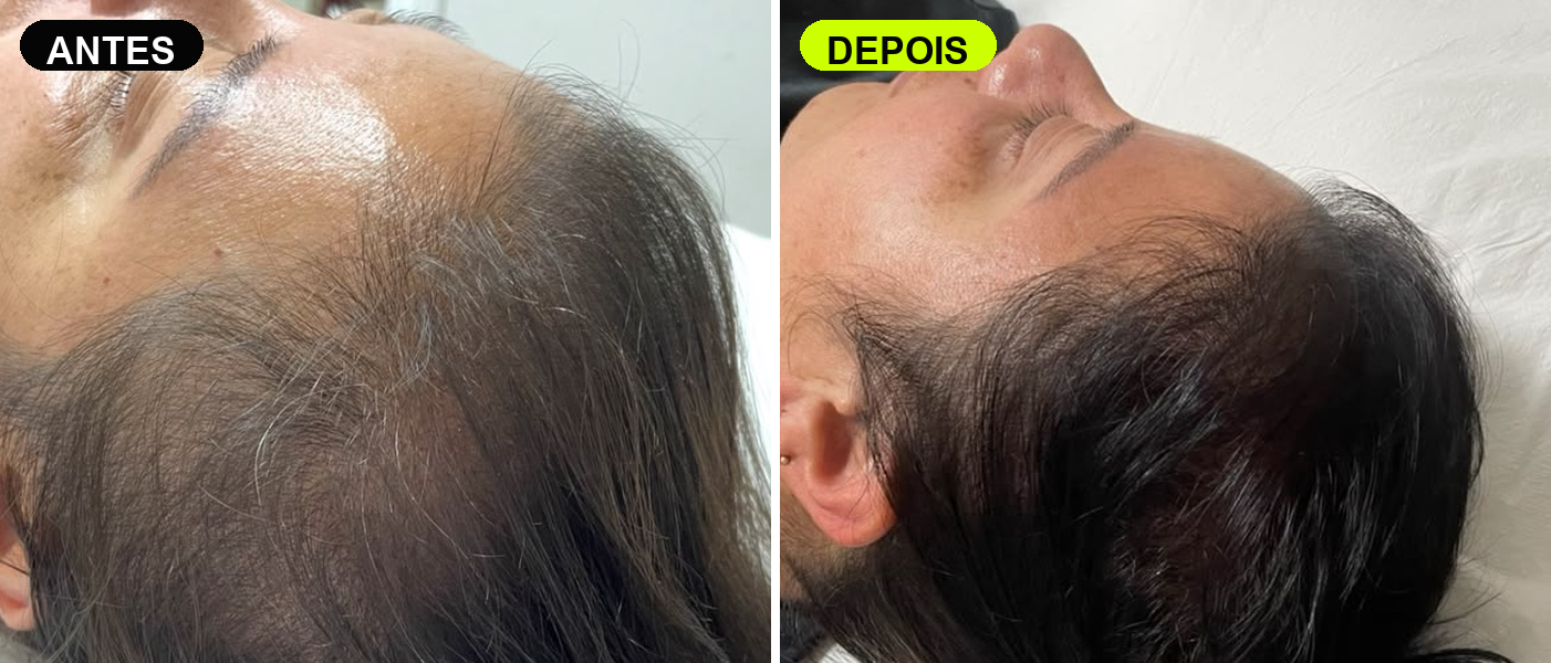 Evolução de tratamento capilar M Hair